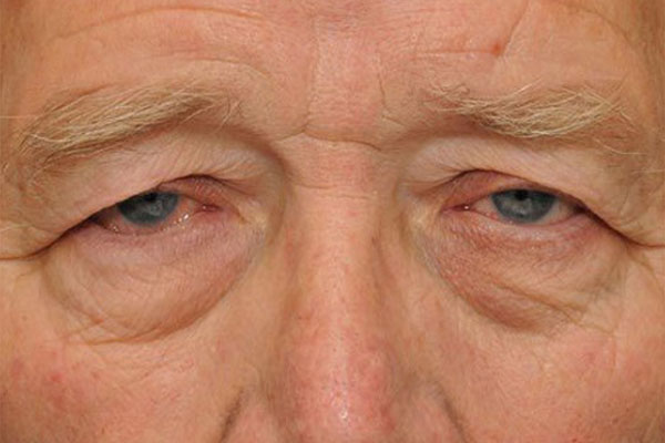 Phương pháp giúp mắt bị sụp mí thành hai mí to tròn 1