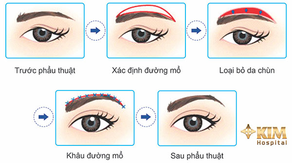 Phương pháp giúp mắt bị sụp mí thành hai mí to tròn 2